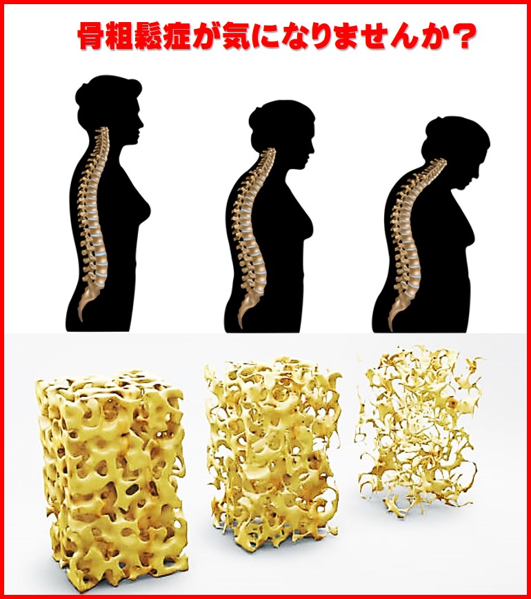 骨粗鬆症の骨の状態